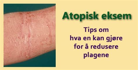 agksem|Eksem – symptom, råd och behandling .